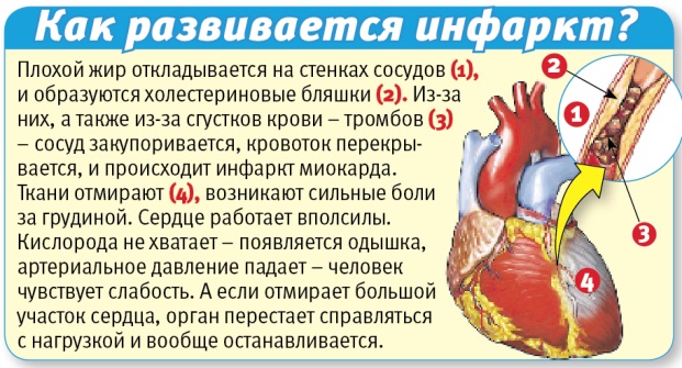 Как развивается инфаркт миокарда?